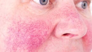 Rosacea Remedies
