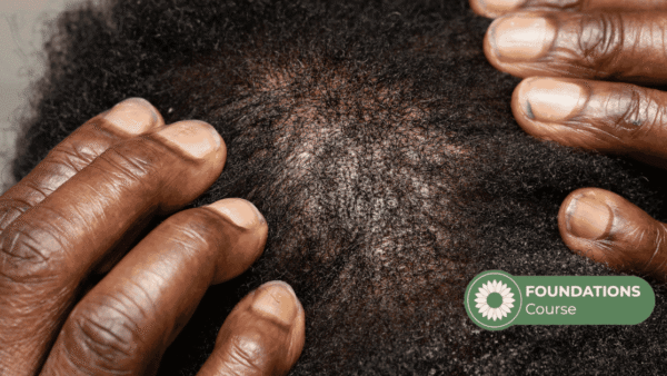 Baldness Alopecia